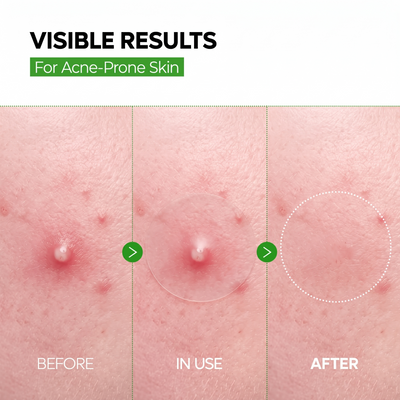 INNATE Zinc Micro Patches